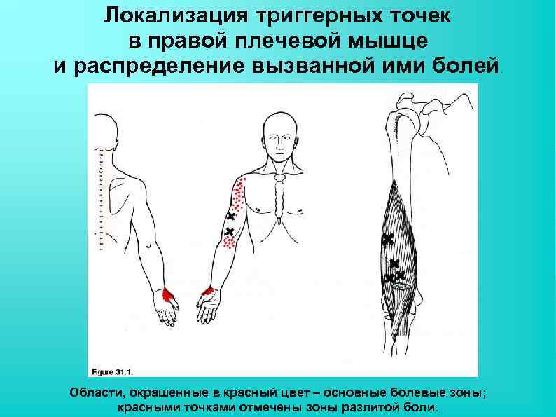 Локализация триггерных точек в правой плечевой мышце и распределение вызванной ими болей Области, окрашенные