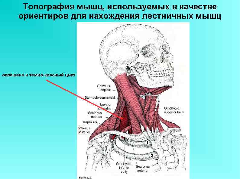 Топография мышц, используемых в качестве ориентиров для нахождения лестничных мышц окрашена в темно-красный цвет