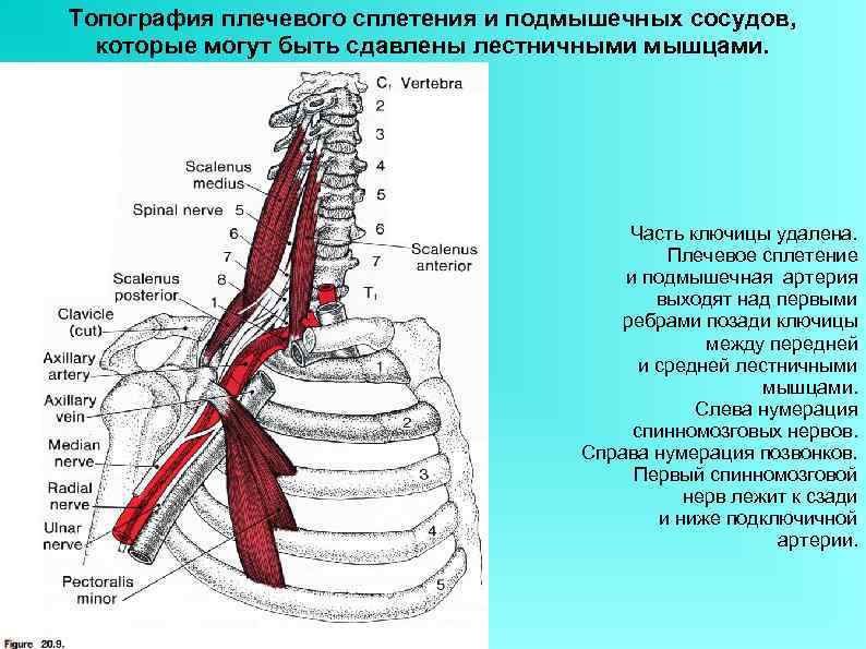 Топография плечевого сплетения и подмышечных сосудов, которые могут быть сдавлены лестничными мышцами. Часть ключицы