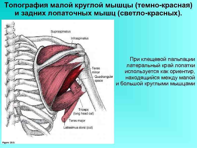 Топография малой круглой мышцы (темно-красная) и задних лопаточных мышц (светло-красных). При клещевой пальпации латеральный