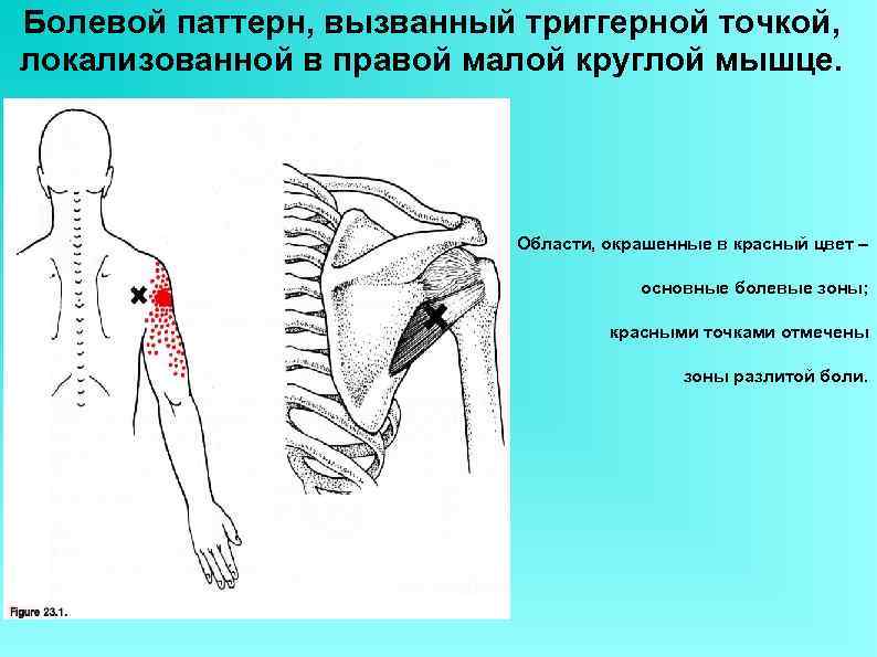 Болевой паттерн, вызванный триггерной точкой, локализованной в правой малой круглой мышце. Области, окрашенные в