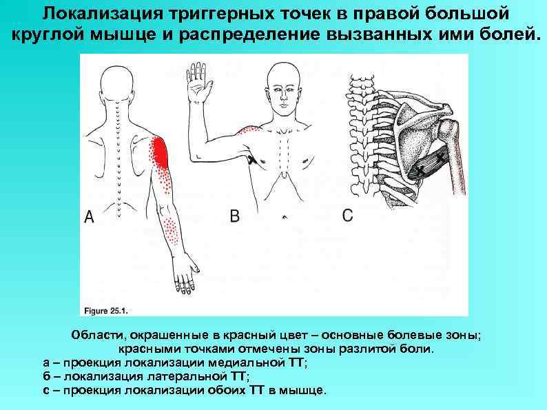 Локализация триггерных точек в правой большой круглой мышце и распределение вызванных ими болей. Области,