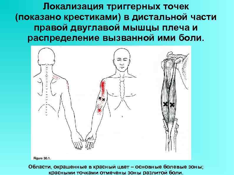 Локализация триггерных точек (показано крестиками) в дистальной части правой двуглавой мышцы плеча и распределение