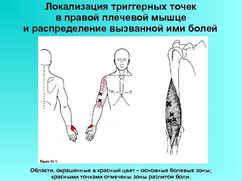 Локализация триггерных точек в правой плечевой мышце и распределение вызванной ими болей Области, окрашенные