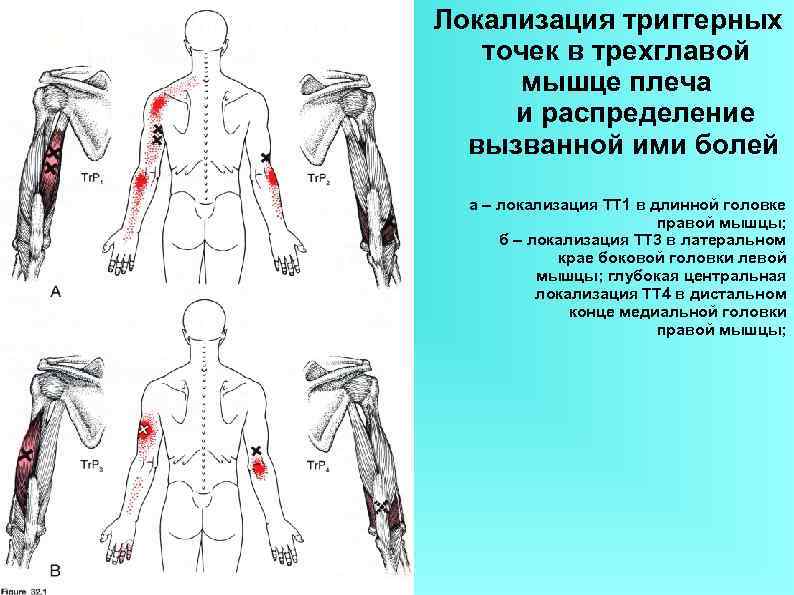 Локализация триггерных точек в трехглавой мышце плеча и распределение вызванной ими болей а –