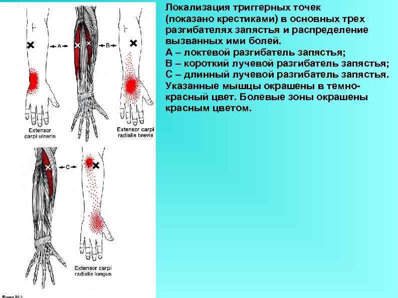 Локализация триггерных точек (показано крестиками) в основных трех разгибателях запястья и распределение вызванных ими