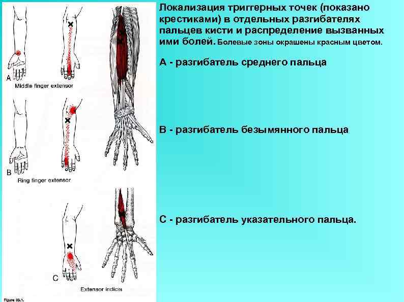 Локализация триггерных точек (показано крестиками) в отдельных разгибателях пальцев кисти и распределение вызванных ими