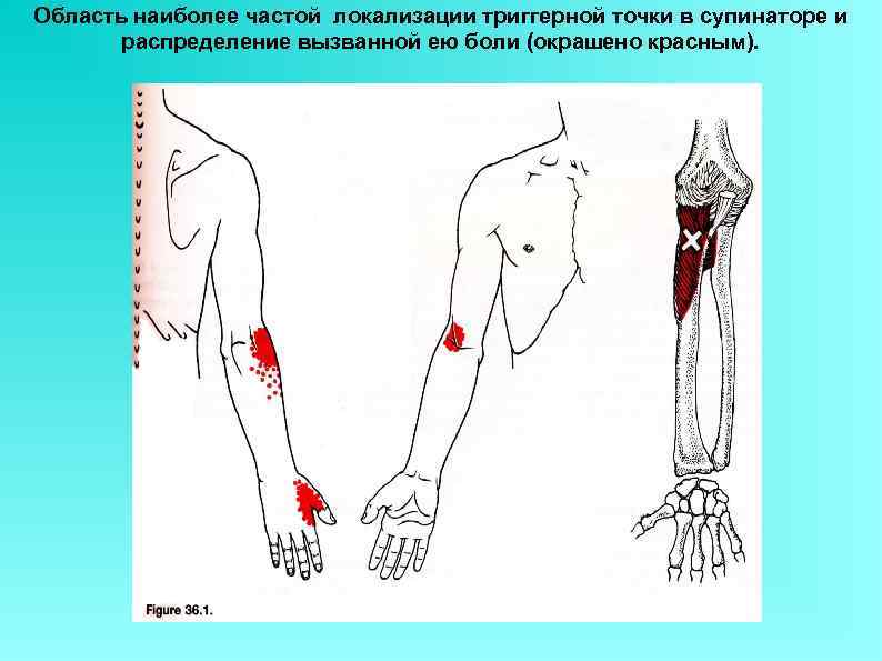 Область наиболее частой локализации триггерной точки в супинаторе и распределение вызванной ею боли (окрашено