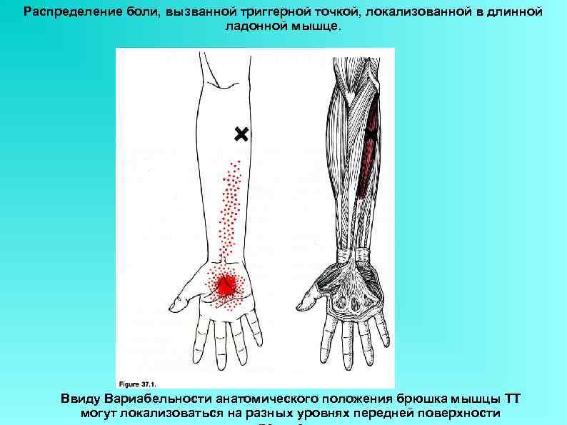 Распределение боли, вызванной триггерной точкой, локализованной в длинной ладонной мышце. Ввиду Вариабельности анатомического положения