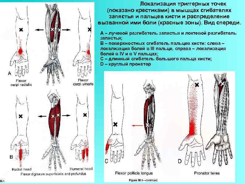 Локализация триггерных точек (показано крестиками) в мышцах сгибателях запястья и пальцев кисти и распределение