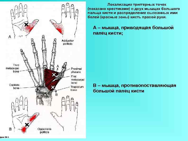 Локализация триггерных точек (показано крестиками) в двух мышцах большого пальца кисти и распределение вызванных