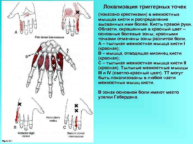 Триггерные точки на руке фото с расшифровкой