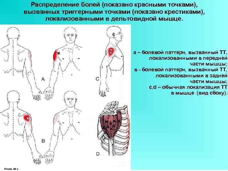 Распределение болей (показано красными точками), вызванных триггерными точками (показано крестиками), локализованными в дельтовидной мышце.