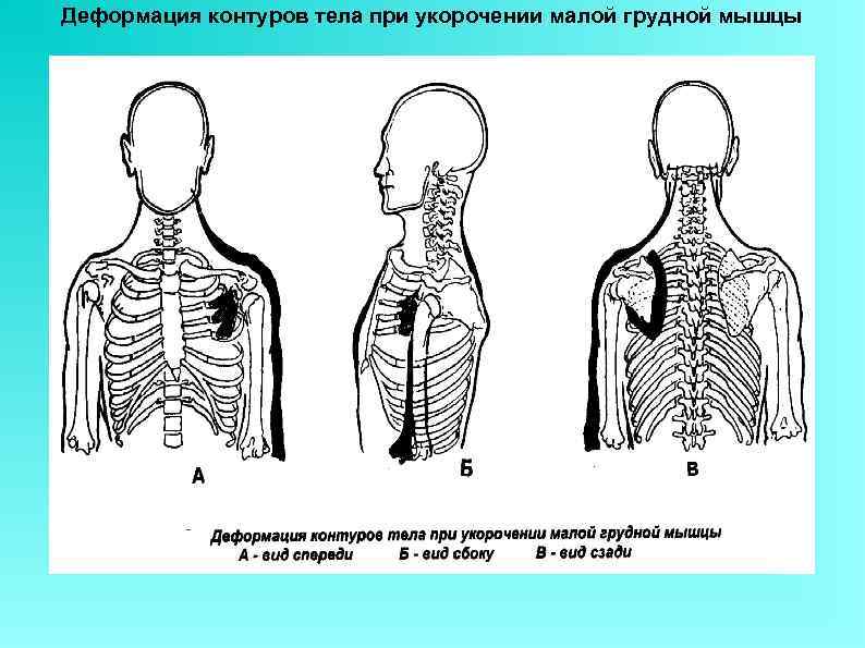 Деформация контуров тела при укорочении малой грудной мышцы 