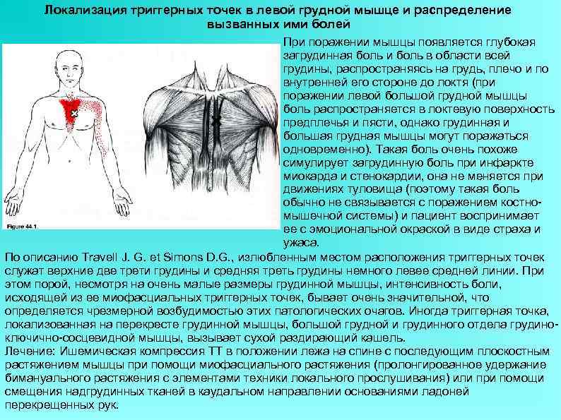 Локализация триггерных точек в левой грудной мышце и распределение вызванных ими болей При поражении