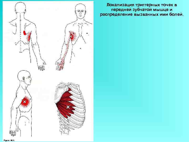 Локализация триггерных точек в передней зубчатой мышце и распределение вызванных ими болей. 