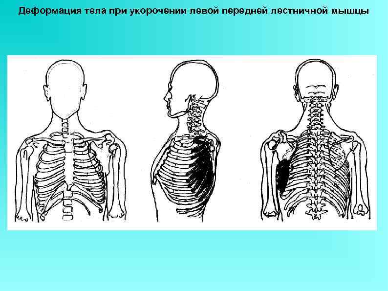 Деформация тела при укорочении левой передней лестничной мышцы 