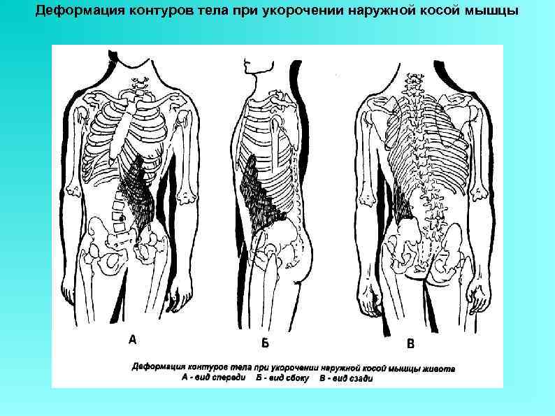 Деформация контуров тела при укорочении наружной косой мышцы 
