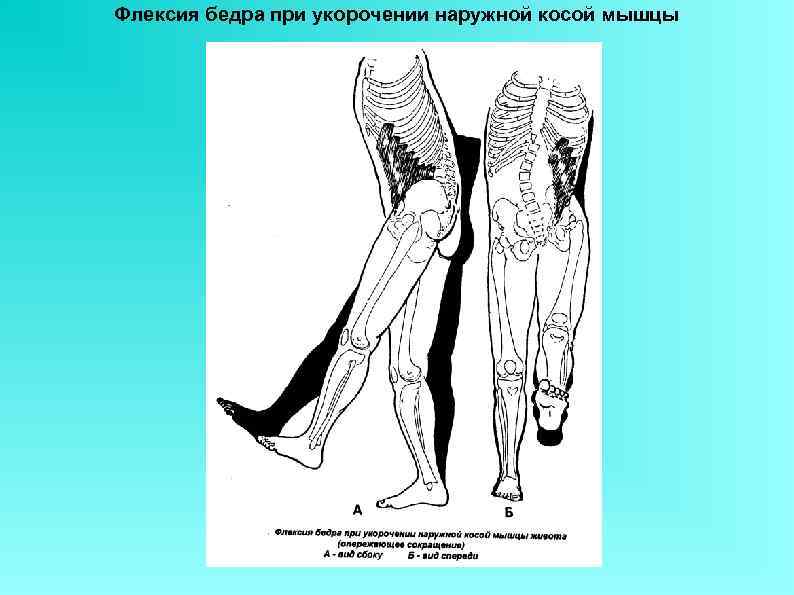 Флексия бедра при укорочении наружной косой мышцы 