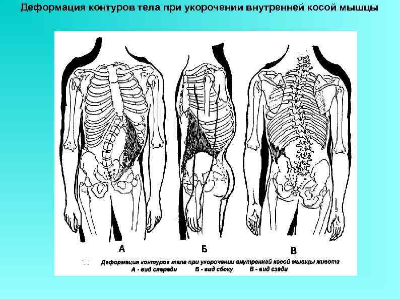 Деформация контуров тела при укорочении внутренней косой мышцы 