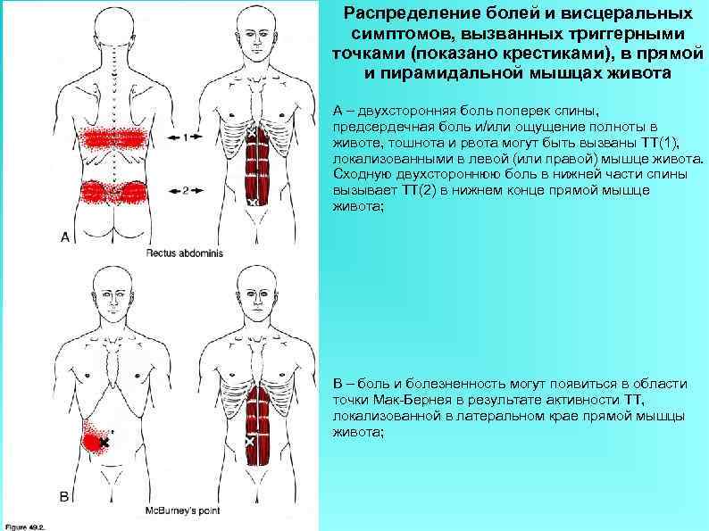 Распределение болей и висцеральных симптомов, вызванных триггерными точками (показано крестиками), в прямой и пирамидальной
