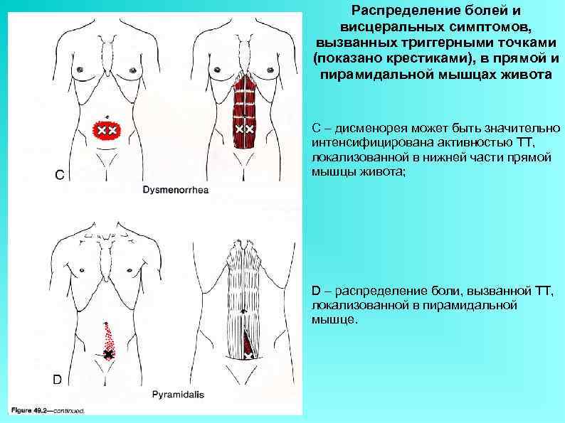 Распределение болей и висцеральных симптомов, вызванных триггерными точками (показано крестиками), в прямой и пирамидальной