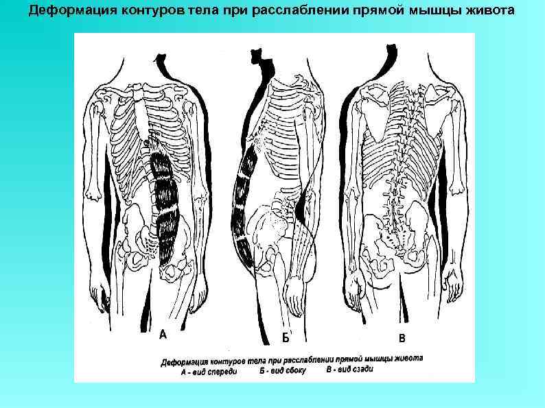 Большого туловища. Триггеры прямой мышцы живота. Триггерные точки прямой мышцы живота. Деформация контуров. Контуры мышц живота.