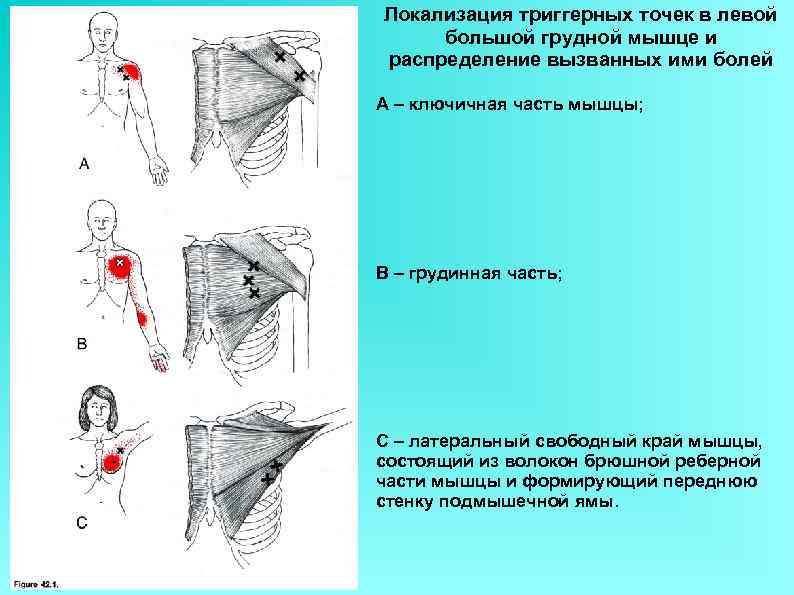 Локализация триггерных точек в левой большой грудной мышце и распределение вызванных ими болей А