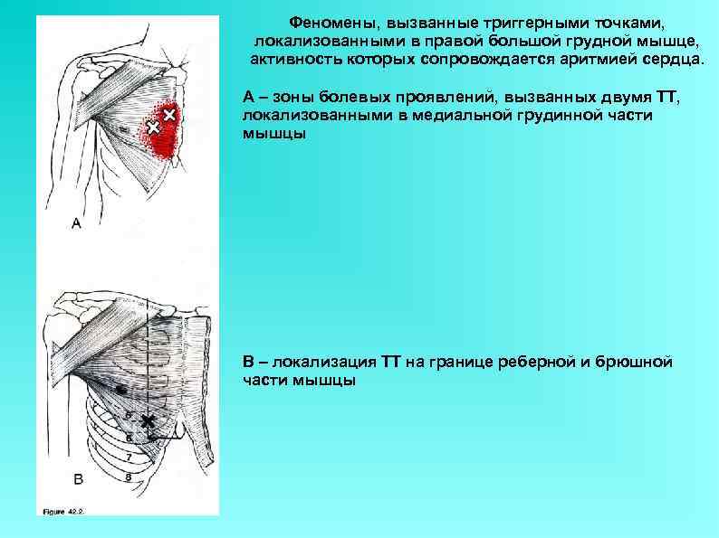 Феномены, вызванные триггерными точками, локализованными в правой большой грудной мышце, активность которых сопровождается аритмией