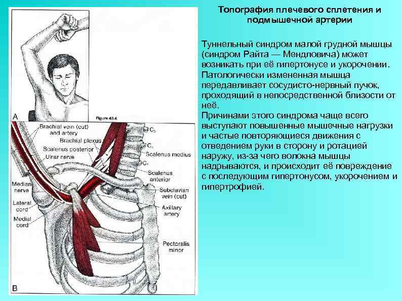 Топография плечевого сплетения и подмышечной артерии Туннельный синдром малой грудной мышцы (синдром Райта —