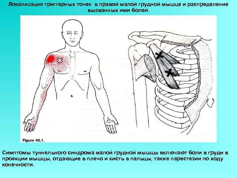 Локализация триггерных точек в правой малой грудной мышце и распределение вызванных ими болей. Симптомы