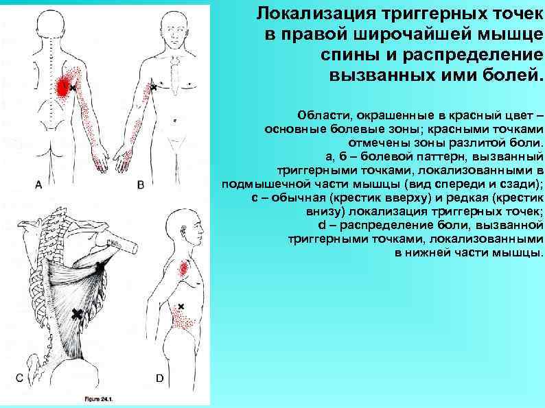 Локализация триггерных точек в правой широчайшей мышце спины и распределение вызванных ими болей. Области,