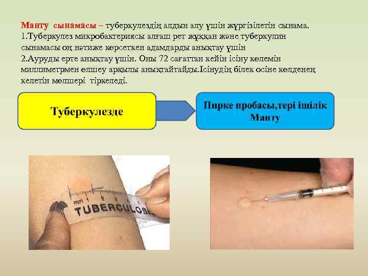 Манту сынамасы – туберкулездің алдын алу үшін жүргізілетін сынама. 1. Туберкулез микробактериясы алғаш рет