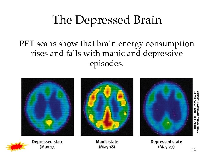 The Depressed Brain PET scans show that brain energy consumption rises and falls with