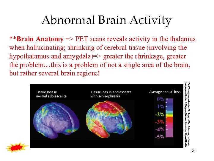 Abnormal Brain Activity **Brain Anatomy => PET scans reveals activity in the thalamus when