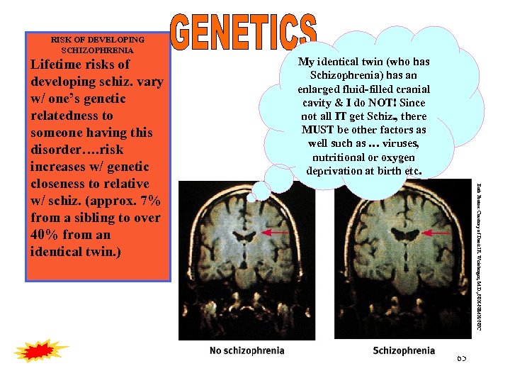 RISK OF DEVELOPING SCHIZOPHRENIA My identical twin (who has Schizophrenia) has an enlarged fluid-filled