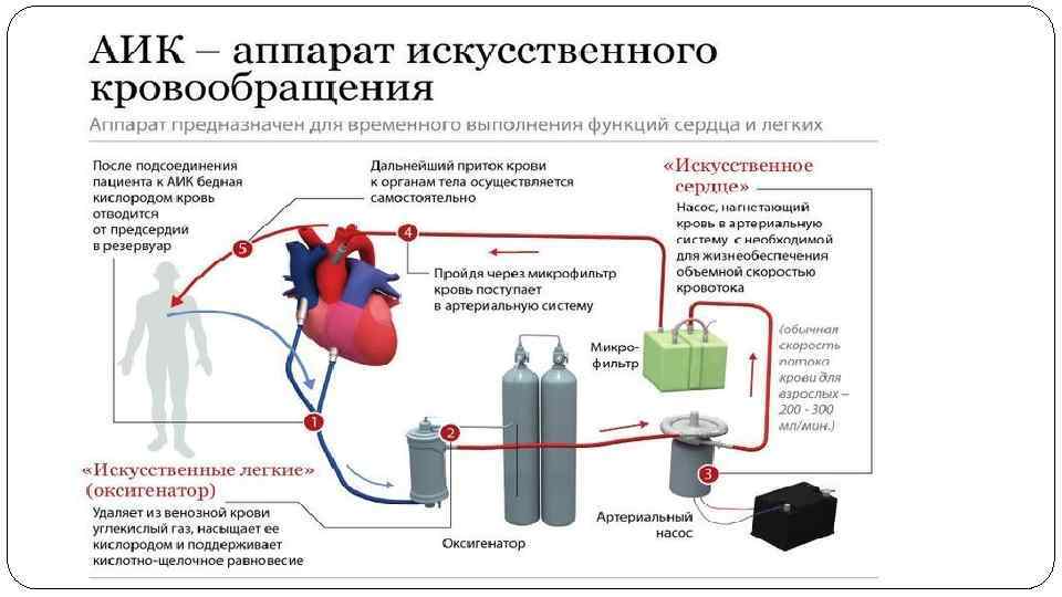 Искусственное кровообращение. АИК аппарат искусственного кровообращения. Искусственное поддержание кровообращения. Искусственное кровообращение сборка аппарата. Аппарат искусственного кровообращения схема.