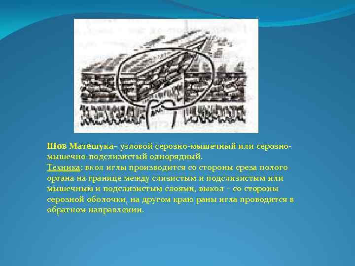 Шов Матешука– узловой серозно мышечный или серозно мышечно подслизистый однорядный. Техника: вкол иглы производится