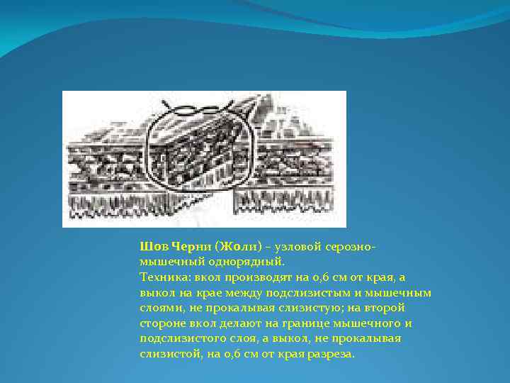 Шов Черни (Жоли) – узловой серозно мышечный однорядный. Техника: вкол производят на 0, 6