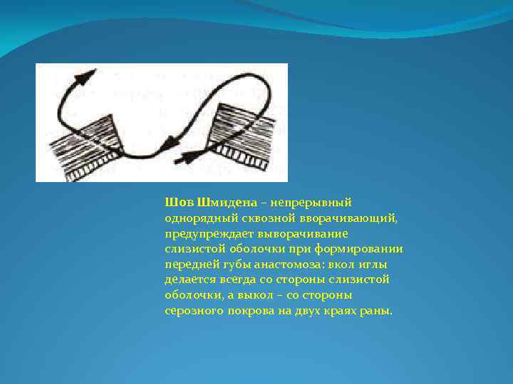 Шов Шмидена – непрерывный однорядный сквозной вворачивающий, предупреждает выворачивание слизистой оболочки при формировании передней