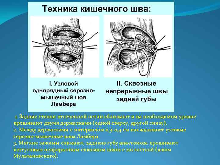  1. Задние стенки отсеченной петли сближают и на необходимом уровне прошивают двумя держалками