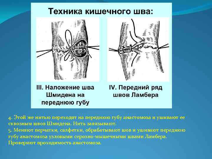 4. Этой же нитью переходят на переднюю губу анастомоза и ушивают ее сквозным швов
