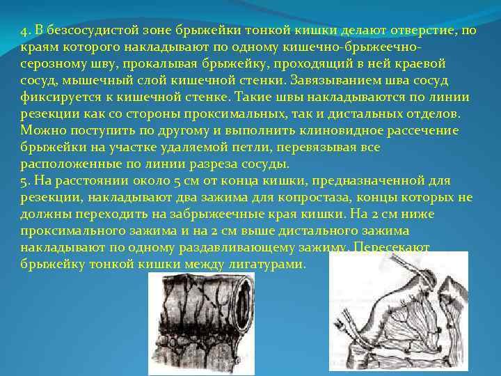 4. В безсосудистой зоне брыжейки тонкой кишки делают отверстие, по краям которого накладывают по