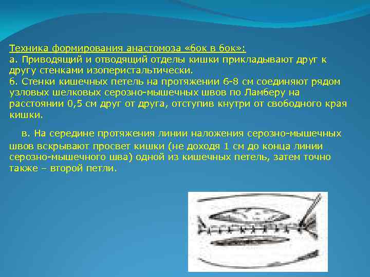 Техника формирования анастомоза «бок в бок» : а. Приводящий и отводящий отделы кишки прикладывают