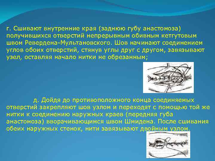  г. Сшивают внутренние края (заднюю губу анастомоза) получившихся отверстий непрерывным обивным кетгутовым швом