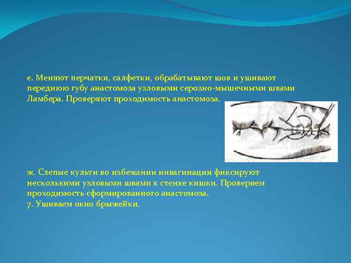 е. Меняют перчатки, салфетки, обрабатывают шов и ушивают переднюю губу анастомоза узловыми серозно мышечными