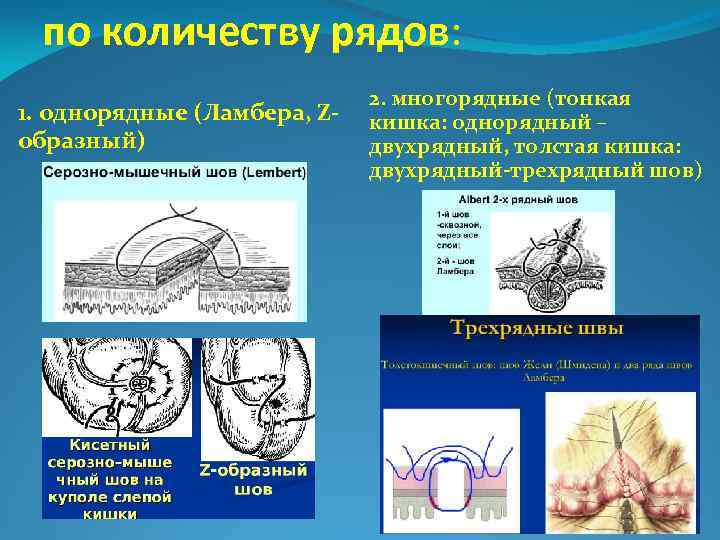 по количеству рядов: 1. однорядные (Ламбера, Zобразный) 2. многорядные (тонкая кишка: однорядный – двухрядный,