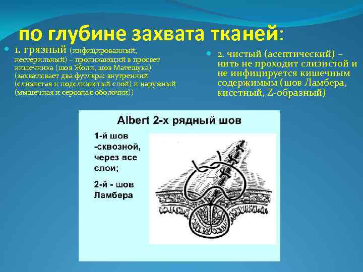 по глубине захвата тканей: 1. грязный (инфицированный, нестерильный) – проникающий в просвет кишечника (шов