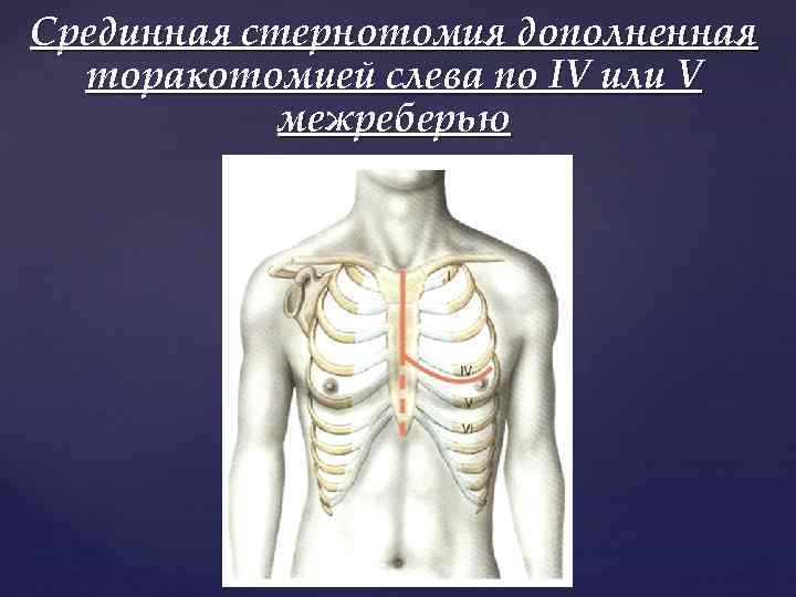 Срединная стернотомия дополненная торакотомией слева по IV или V межреберью 