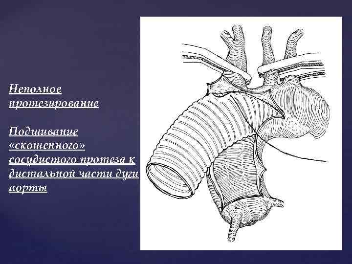 Неполное протезирование Подшивание «скошенного» сосудистого протеза к дистальной части дуги аорты 